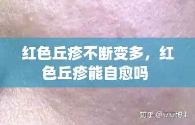 红色丘疹不断变多,红色丘疹能自愈吗