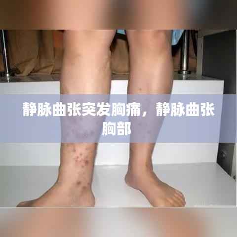 静脉曲张突发胸痛,静脉曲张胸部