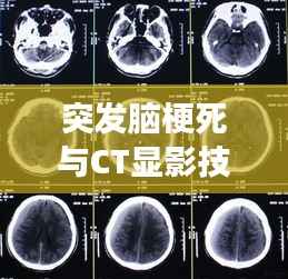 突发脑梗死与CT显影技术,现代医学的精准洞察之旅